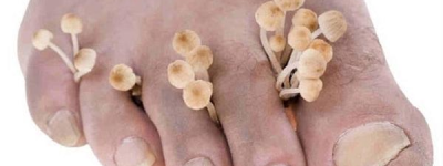 臭脚百科：脚趾甲下的细菌乐园，揭秘脚臭之